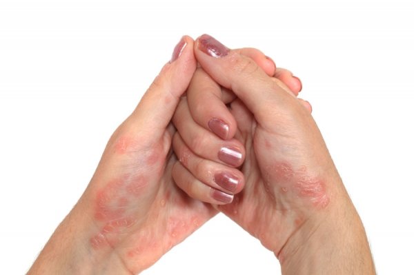 Псоріаз на руках - стадії, причини і лікування захворювання